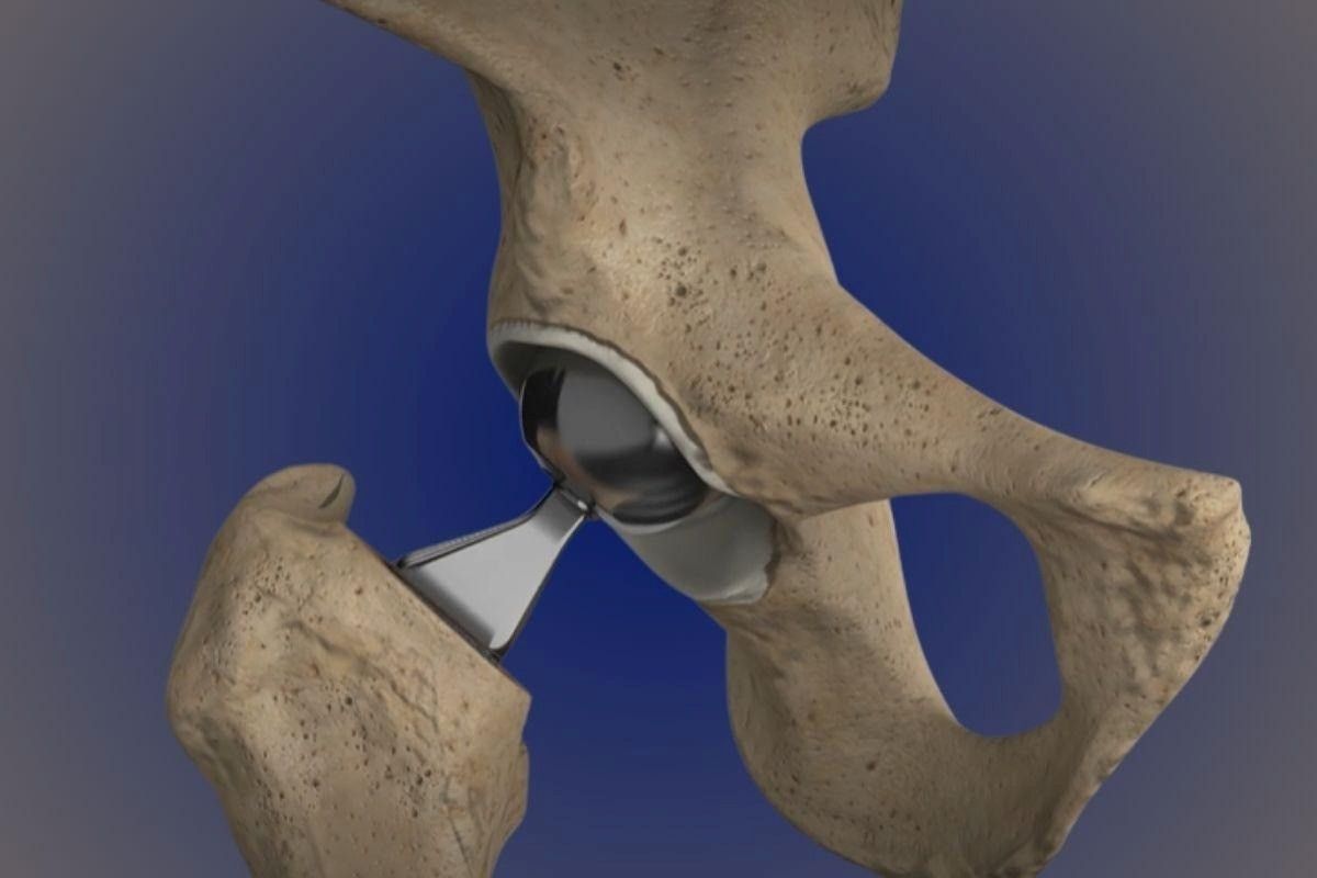 Artroplastia parcial do quadril: quando indicamos?