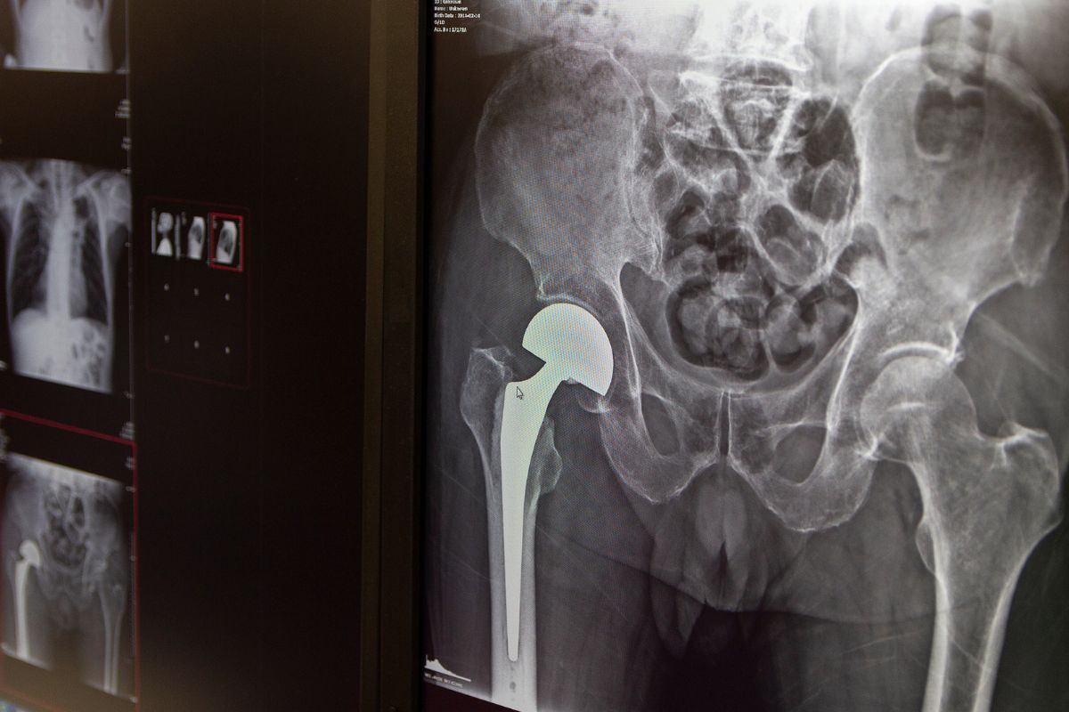 Artroplastia total do quadril: entenda a cirurgia