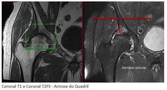 artrose-quadril-dr-ricardo-kirihara-ortopedista-cirurgia-quadril-sao-paulo