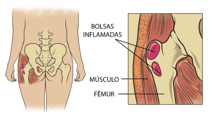 bursite-trocanterica-causas-dr-ricardo-kirihara-ortopedista-quadril-sao-paulo