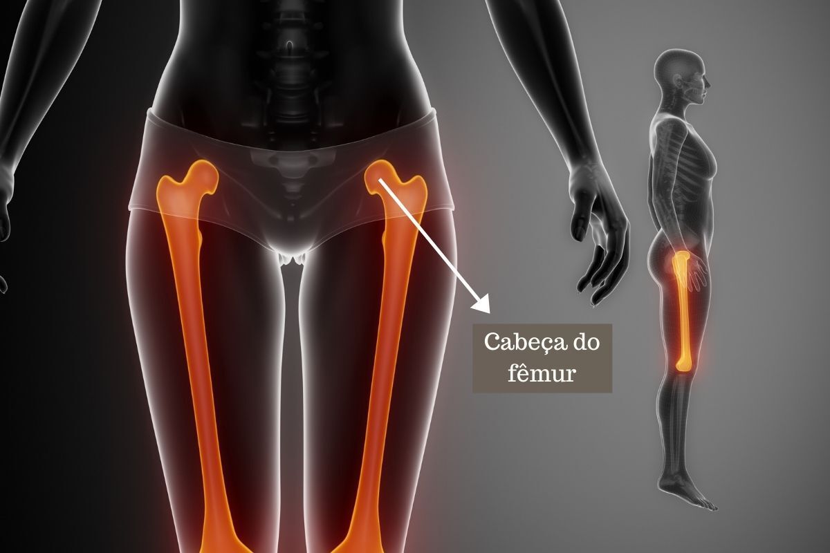 dr-ricardo-kirihara-ortopedista-quadril-osteonecrose-femur-sao-paulo