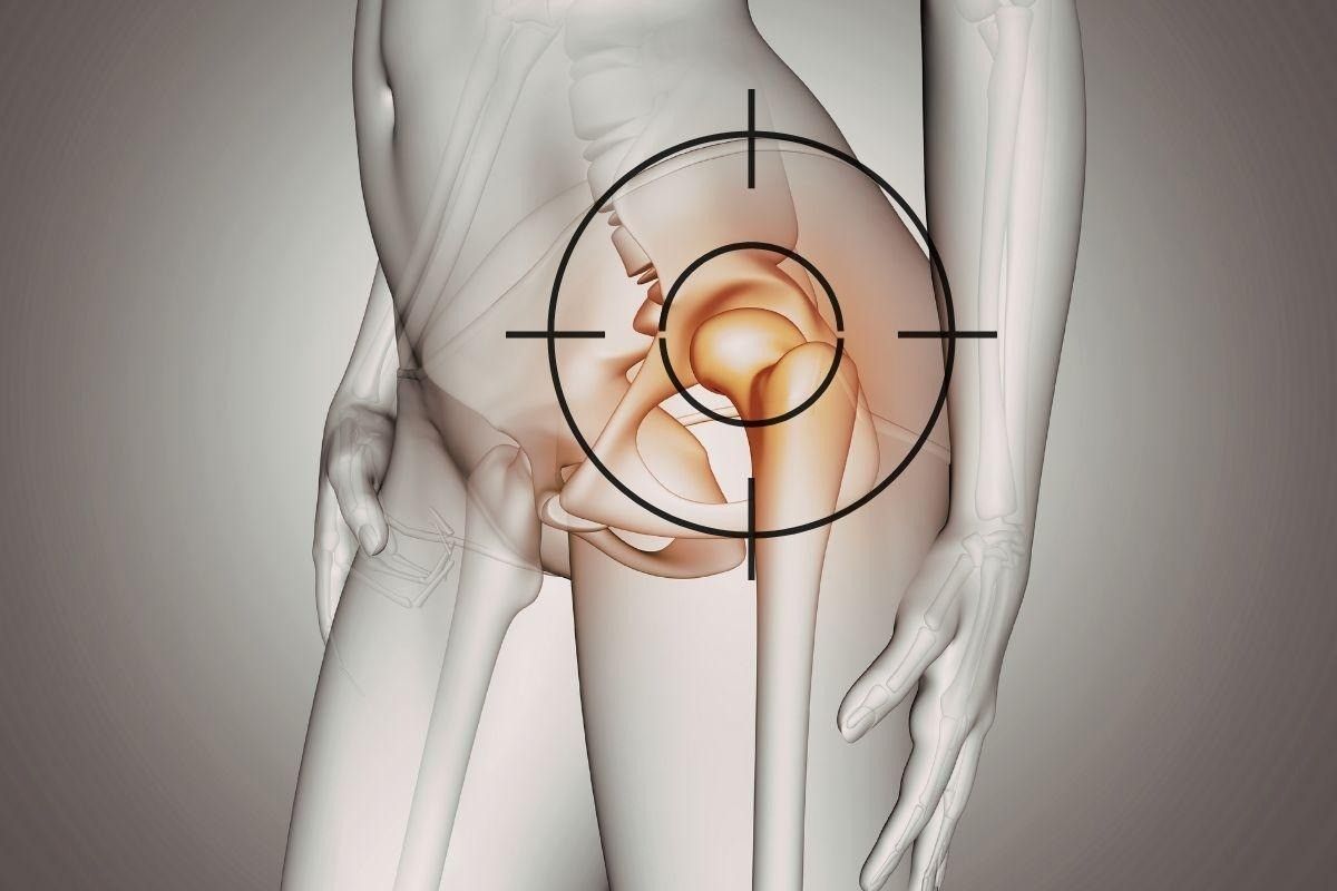 Lesão do labrum do quadril: saiba como identificar os sinais