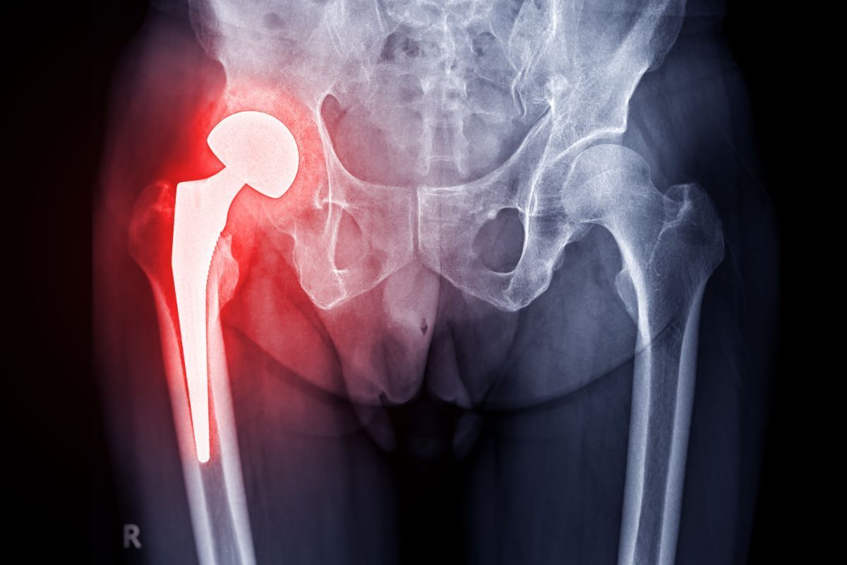 protese-quadril-dr-ricardo-kirihara-ortopedista-quadril-sao-paulo