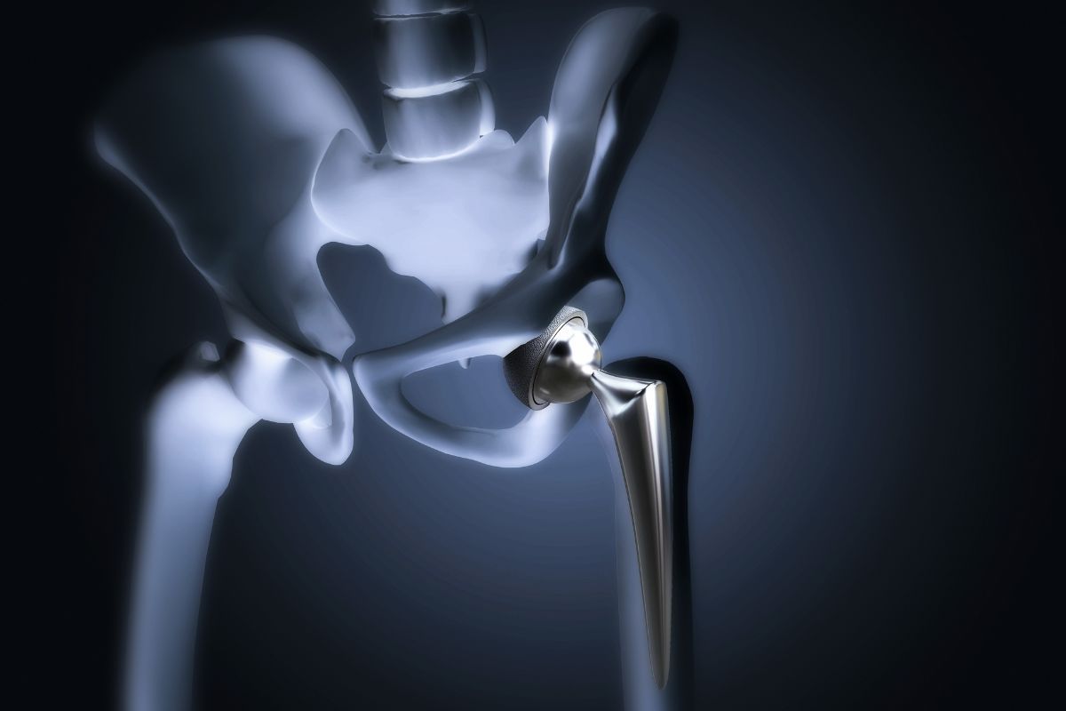 Qual a melhor prótese de quadril? Entenda!