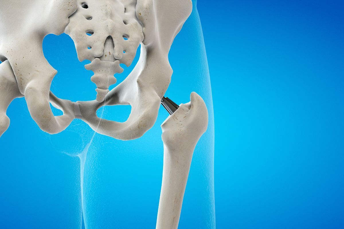 Revisão de prótese de quadril: entenda quando ela é necessária