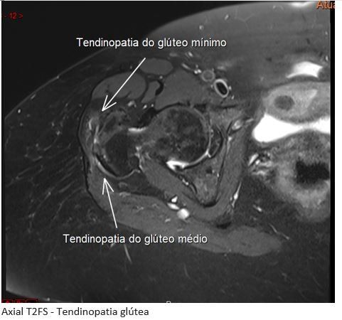 tendinopatia-quadril-dr-ricardo-kirihara-ortopedista-cirurgia-quadril-sao-paulo