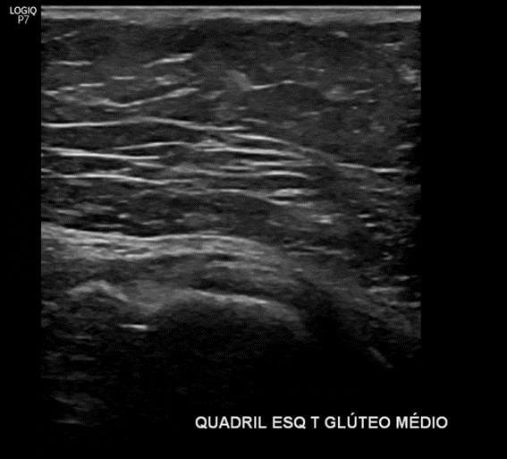 Ultrasson quadril Dr Ricardo Kirihara