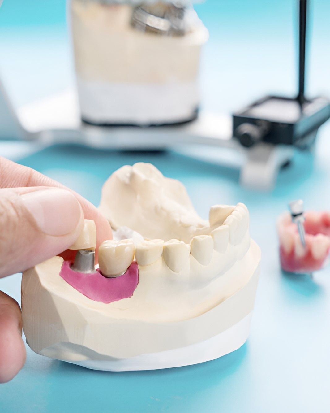 A Person is Putting a Dental Crown on a Model of Teeth — Yeppoon Denture Clinic in Taranganba, QLD