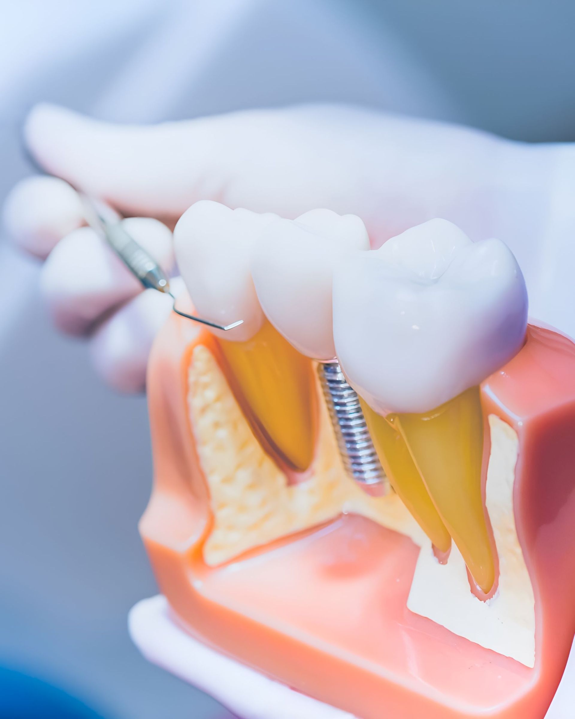 A Person is Holding a Model of a Dental Implant in Their Hand — Yeppoon Denture Clinic in Taranganba, QLD