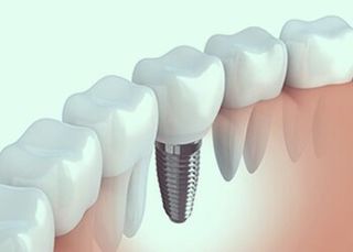 Implants—Dentists in Whittier, NC