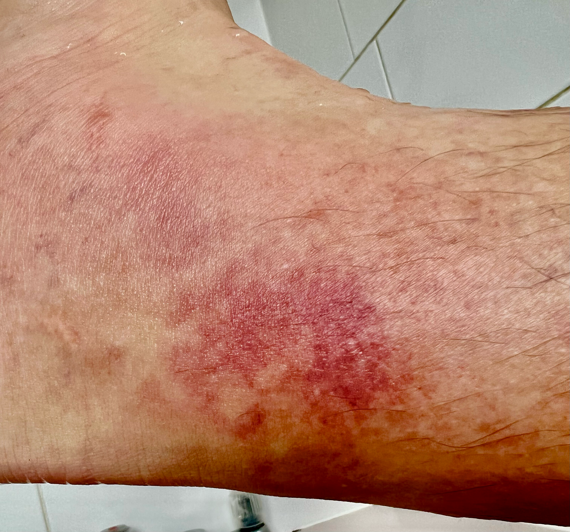 bumble bee sting on ankle