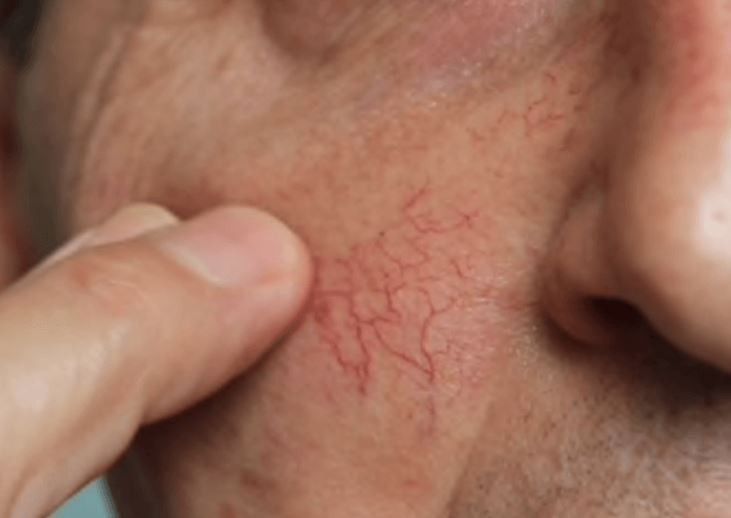 A close up of a person 's face with red veins.