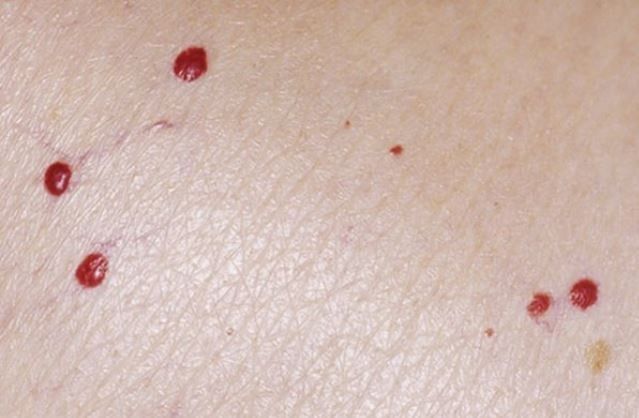 A close up of a person 's skin with red spots on it.