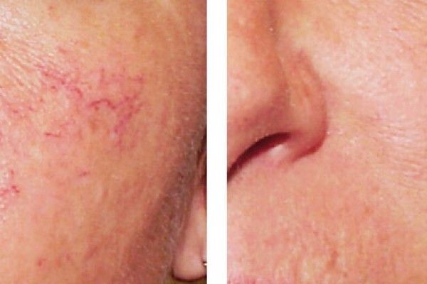 A before and after photo of a woman 's face with red veins.