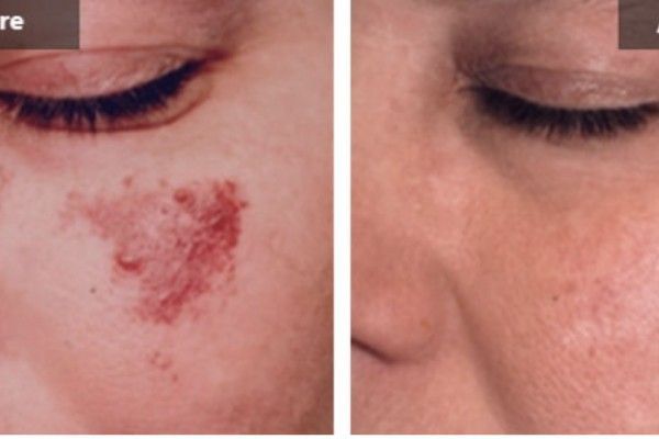 A before and after photo of a woman 's face