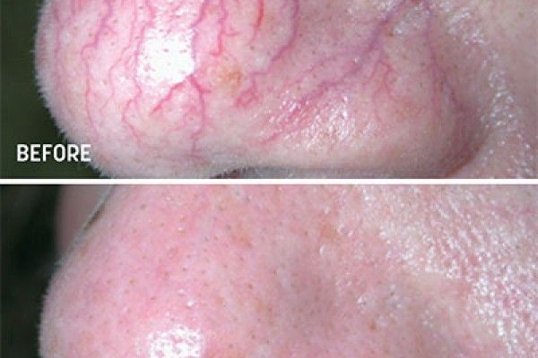 A before and after photo of a person 's nose with red veins.