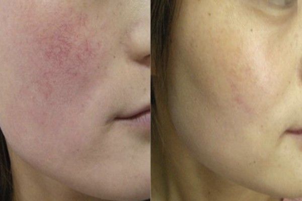 A before and after photo of a woman 's face with red veins.
