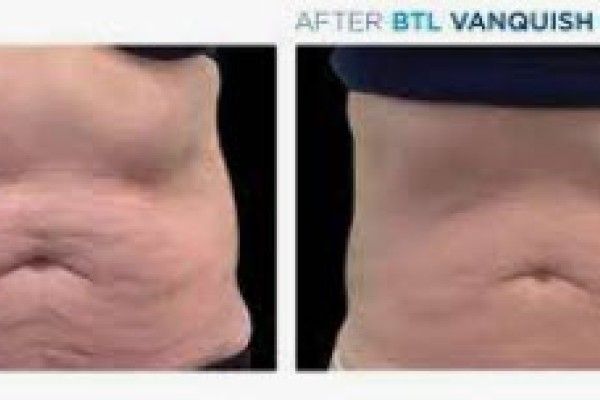 A before and after picture of a woman 's stomach.