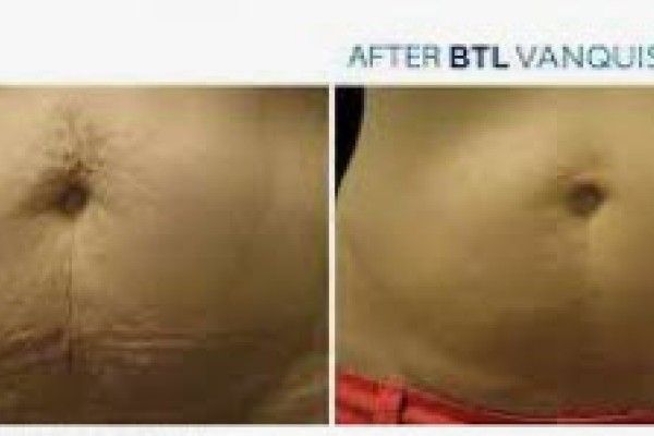 A before and after photo of a woman 's stomach with stretch marks.
