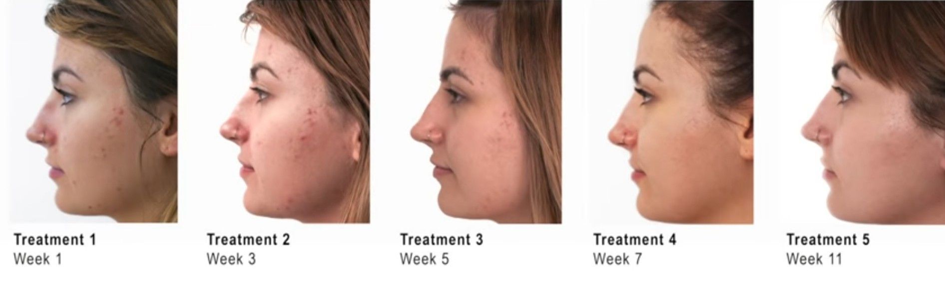 A woman 's face is shown in different stages of treatment.