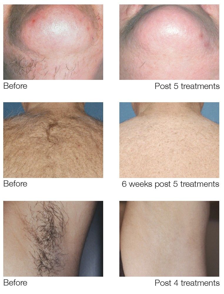 A before and after picture of a person 's hair removal treatment.