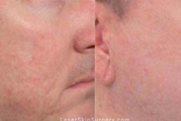 A before and after photo of a man 's face