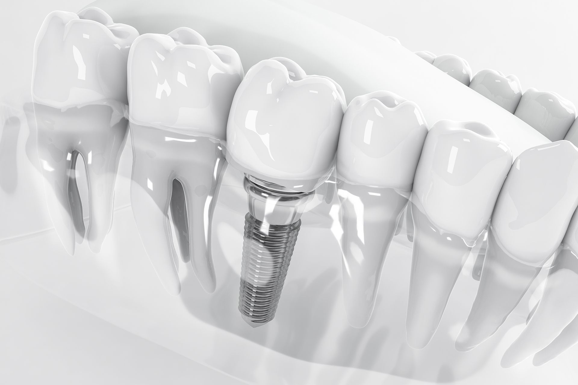 Dental implant: white crown attached to a metal post in a transparent jaw model.