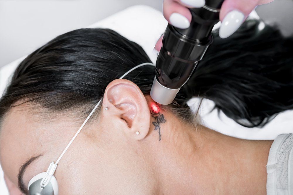 Laser Tattoo Removal Procedure — Jacksonville, FL — Ageless Rejuvenation Center