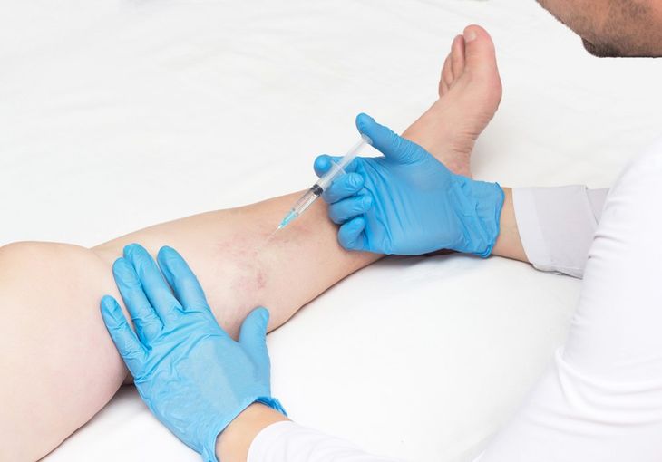 Sclerotherapy For Spider Veins — Jacksonville, FL — Ageless Rejuvenation Center