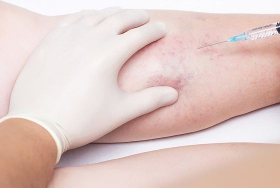 Spider Vein Treatment — Jacksonville, FL — Ageless Rejuvenation Center
