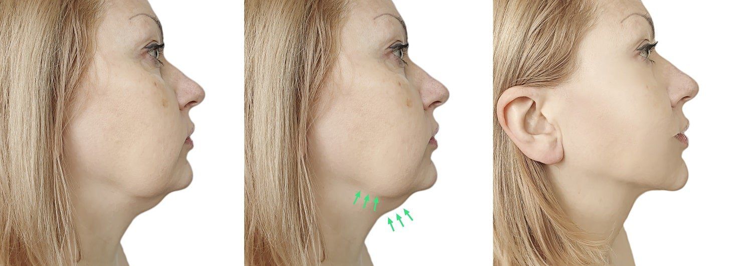 how-long-does-it-take-for-kybella-to-work