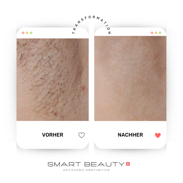 Discover more than 137 laser hair removal zurich latest tnbvietnam.edu.vn