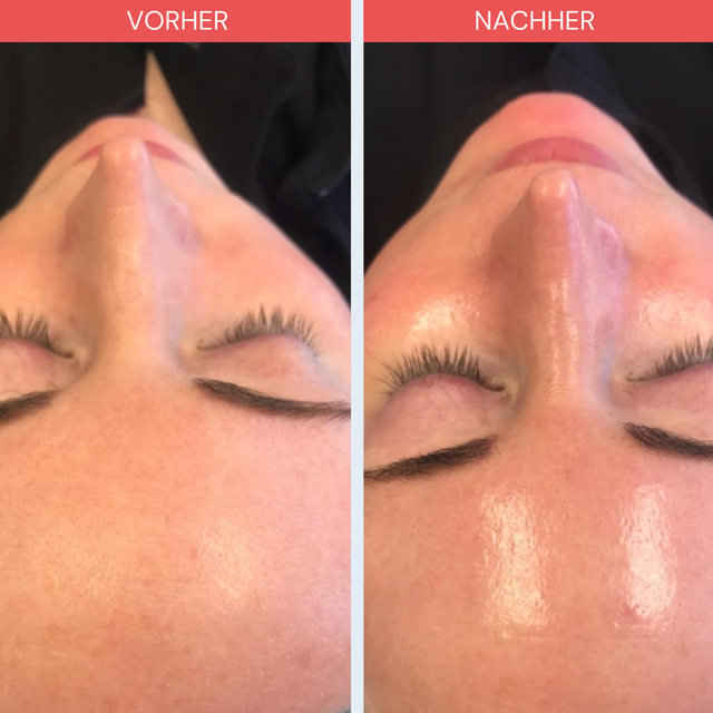 Hydrafacial - Beste Gesichtsbehandlungen in Zürich