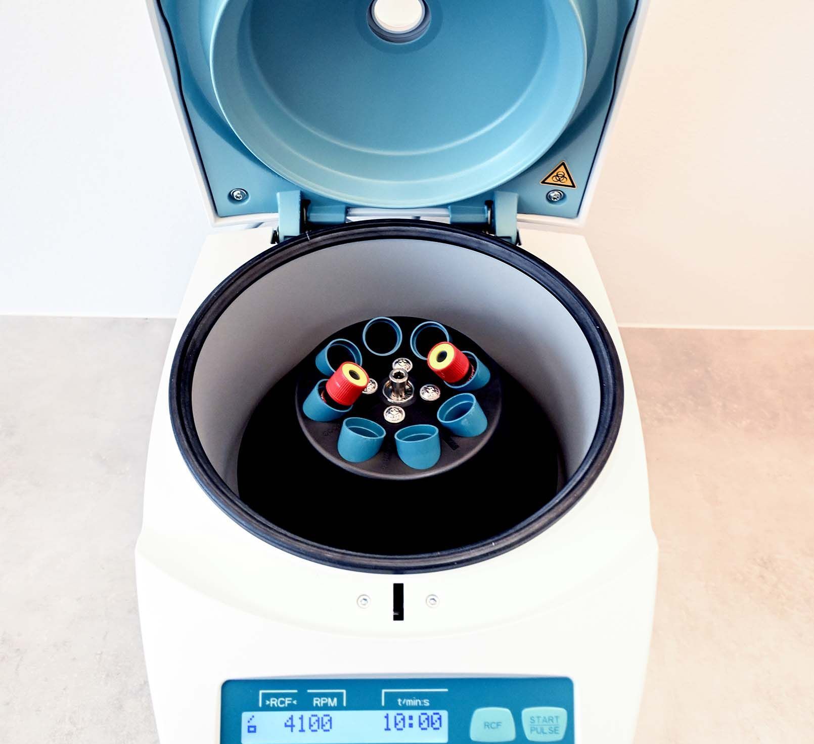 Person hält abgenommenes Blut in einer Spritze für die Eigenbluttherapie