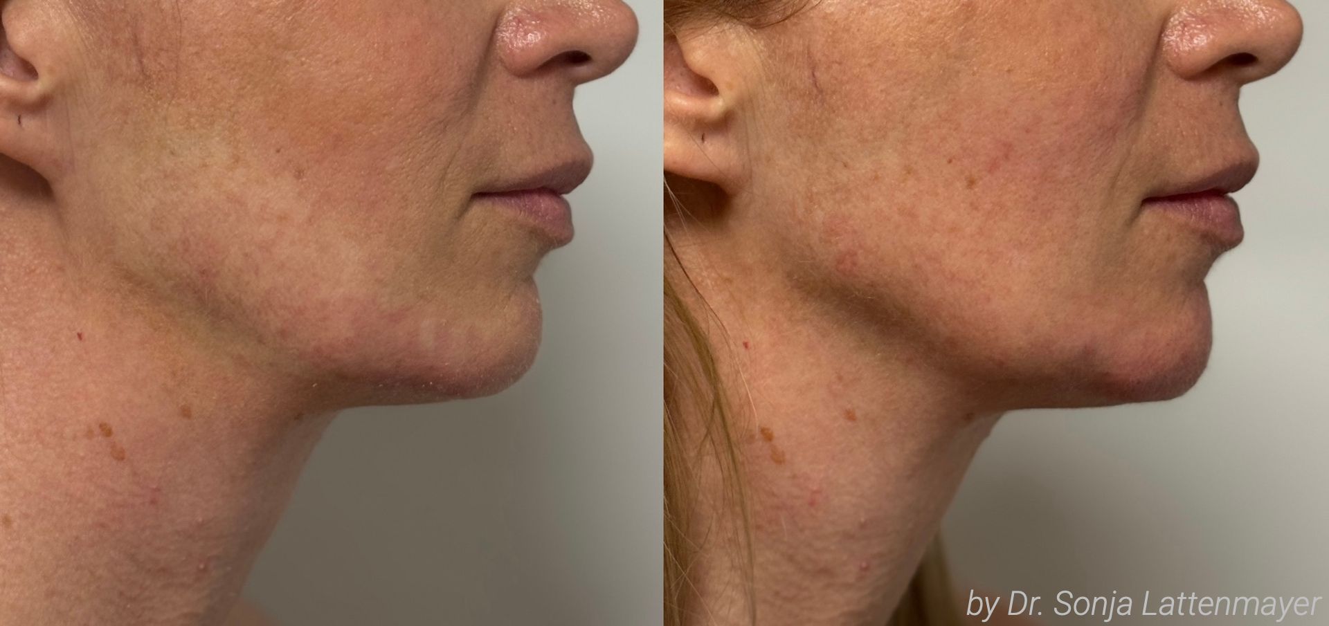Ein Vorher-Nachher-Bild der Jawline einer Frau behandelt mit einem Filler.