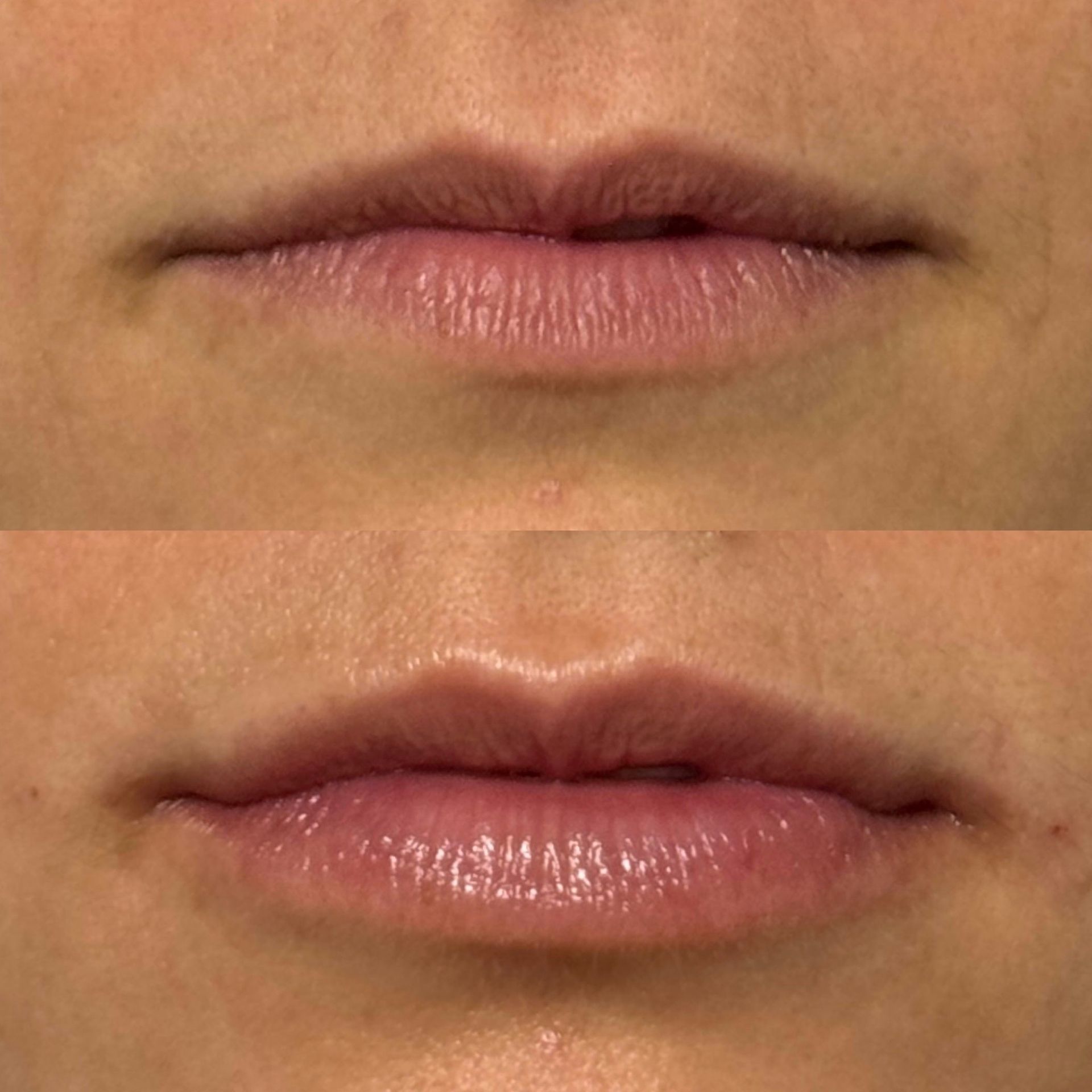 Ein Vorher-Nachher-Bild der Lippen einer Frau behandelt mit einem Lipp Filler.