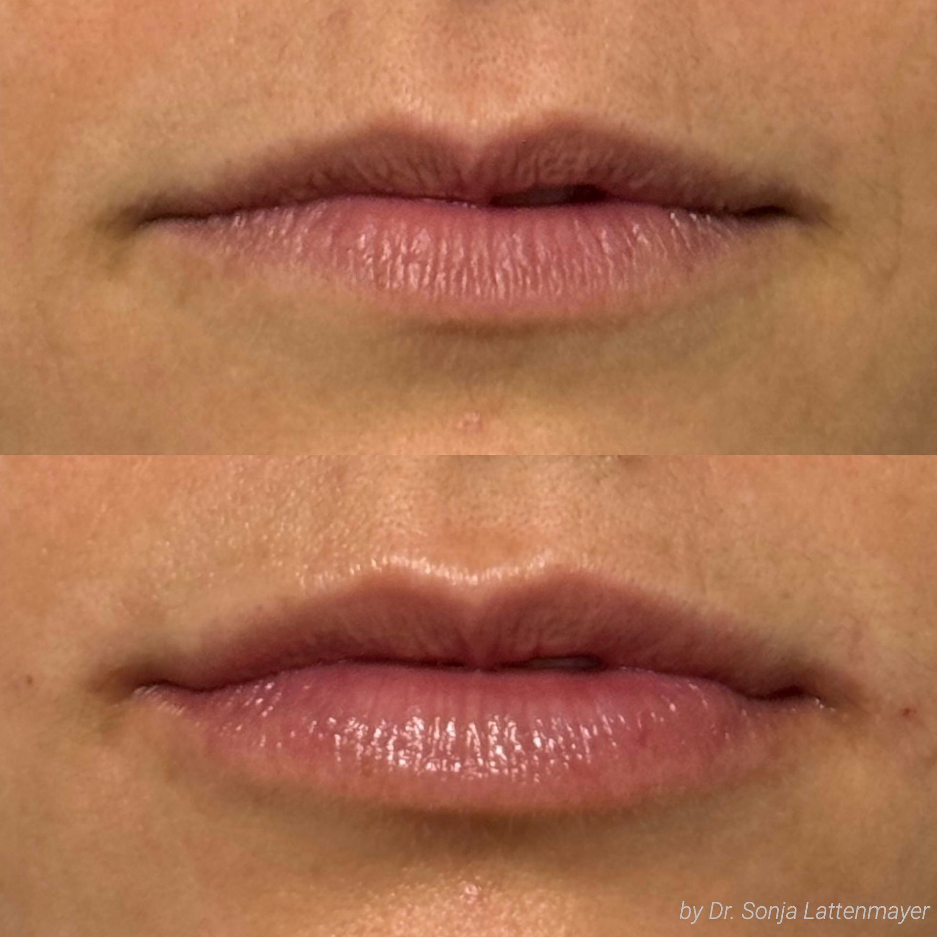 Ein Vorher-Nachher-Bild der Lippen einer Frau behandelt mit einem Lipp Filler.