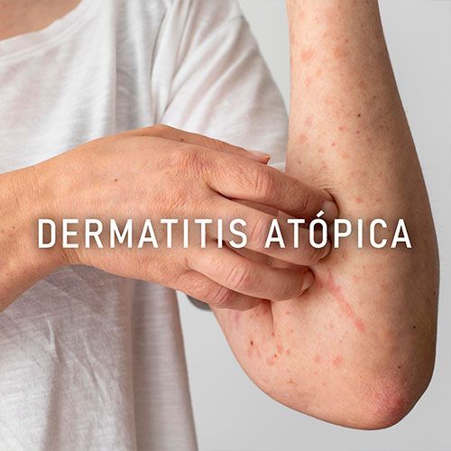 Dr. Alberto Monteverde Maldonado - DERMATITIS