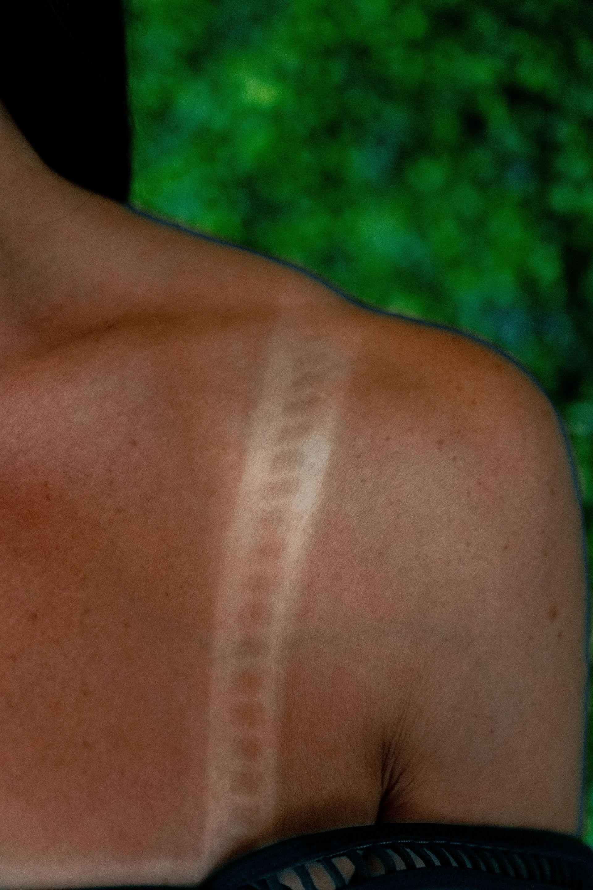 Shoulder with tan lines from a strap, showing light skin under the strap and tan skin elsewhere, against a green background.