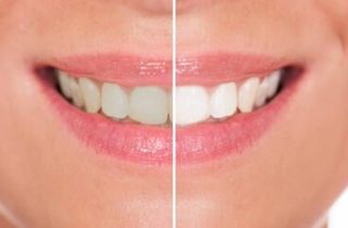 Before & After Teeth Whitening — Dental Services in Bridgewater, MA