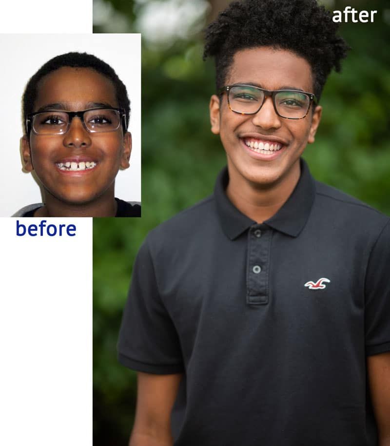 Smiling teen with straightened teeth, wearing glasses and a black polo shirt, before and after braces.