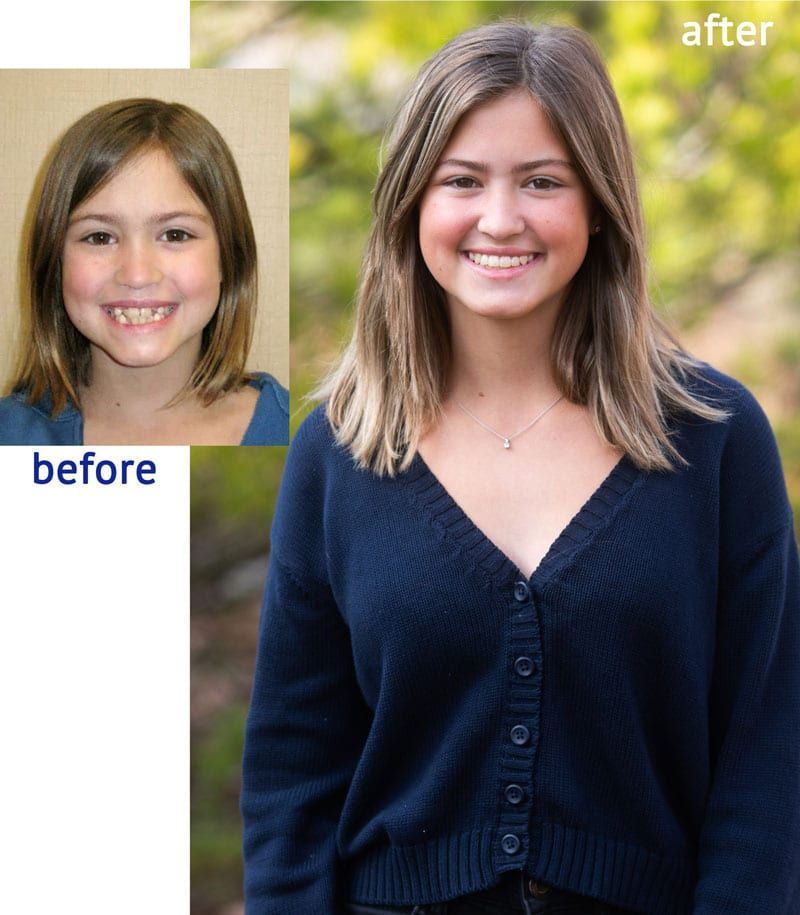 Comparison of a girl's before and after orthodontic treatment. Before: young girl smiling, visible gaps. After: smiling teen with straighter teeth.