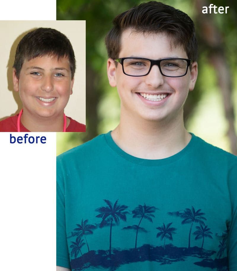 Before and after photos of a smiling teen, showing improved smile after dental work; outdoors with glasses.