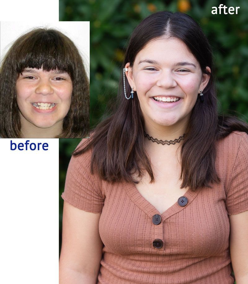 Before-and-after photo of a young woman. Before photo shows her with bangs and braces. After photo shows her smiling with straight teeth and long hair.