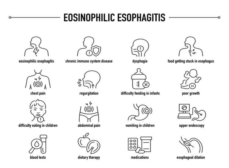 eosinophilic-esophagitis symptoms and causes  chart