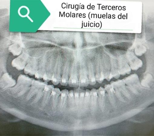 DR. ROBERTO SILVA RIVERA – Cirugía muelas del juicio