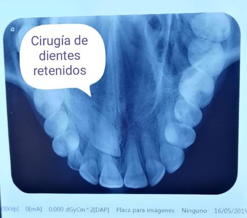 DR. ROBERTO SILVA RIVERA – Cirugía dientes retenidos
