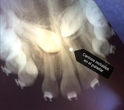 DR. ROBERTO SILVA RIVERA – Caninos incluidos