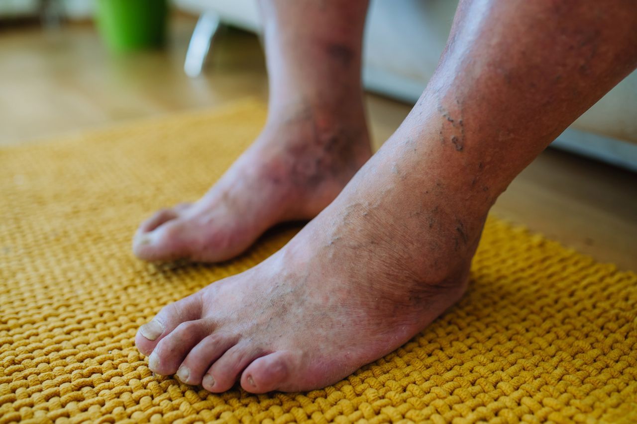 A person with varicose veins on their legs is standing on a yellow rug.