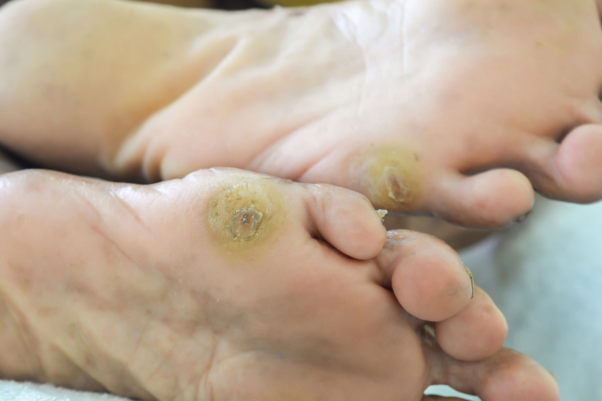 A close up of a person 's feet with warts on them.